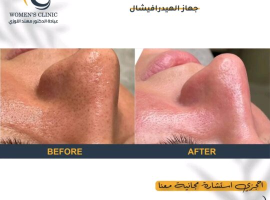 نتائج جلسة تنظيف البشرة بـ #الهايدرافيشل 💆‍♀